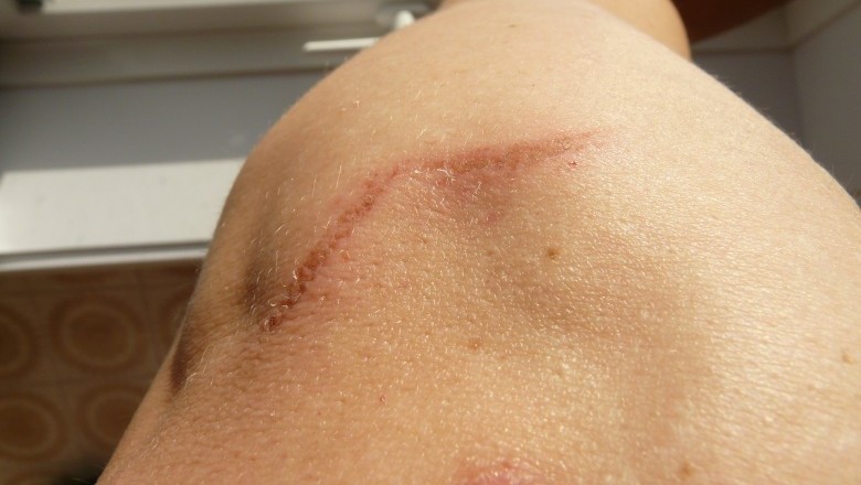 Scar Removal - Try Home Remedies for Scars