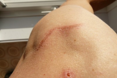 Scar Removal - Try Home Remedies for Scars