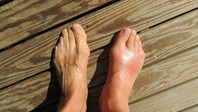 How Do You Know If You Have Gout?