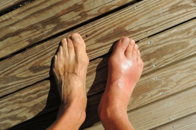 How Do You Know If You Have Gout?