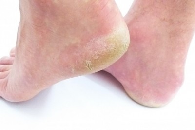 Skin Fungus Infections (Symptoms and Treatments)